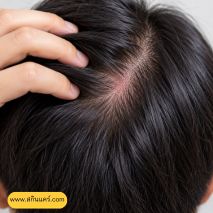 แชมพูอะไรดีสําหรับหนังศีรษะแพ้ง่าย